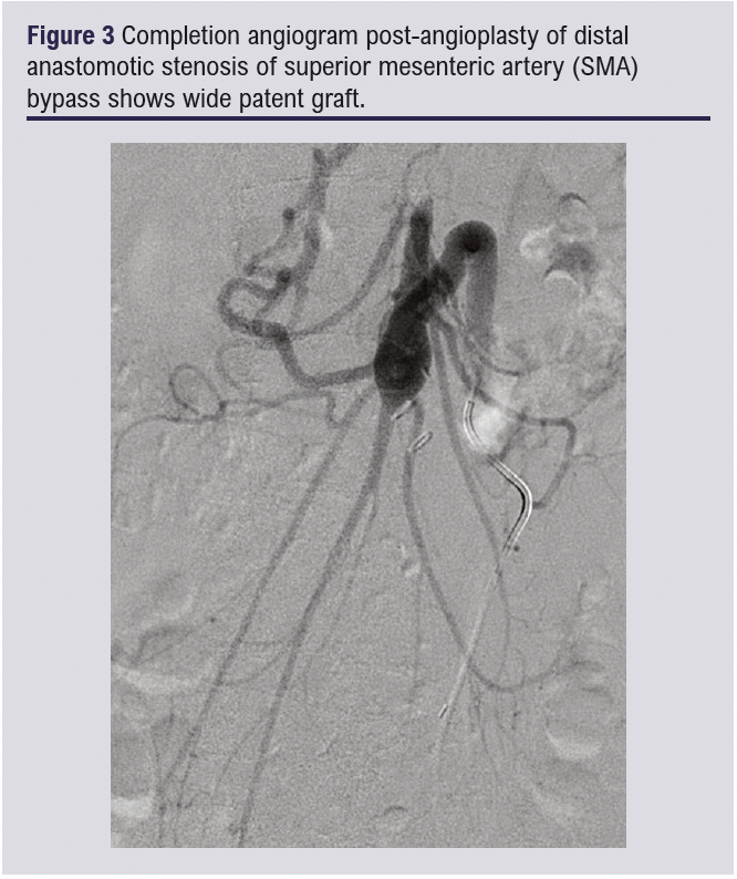 Ilio-mesenteric bypass for chronic mesenteric ischaemia where prior ...